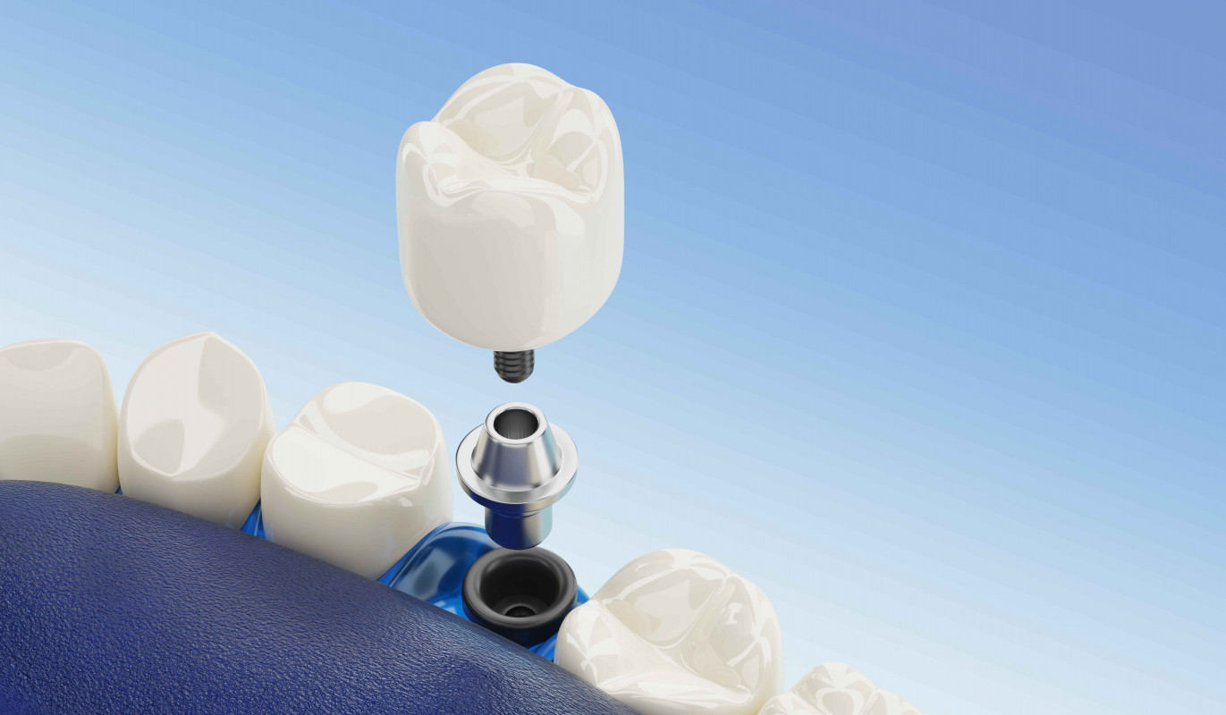 Single tooth implant with zirconium veneer